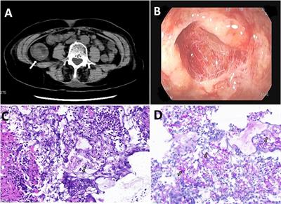 A rare intestinal mucormycosis caused by Lichtheimia ramosa in a patient with diabetes: a case report